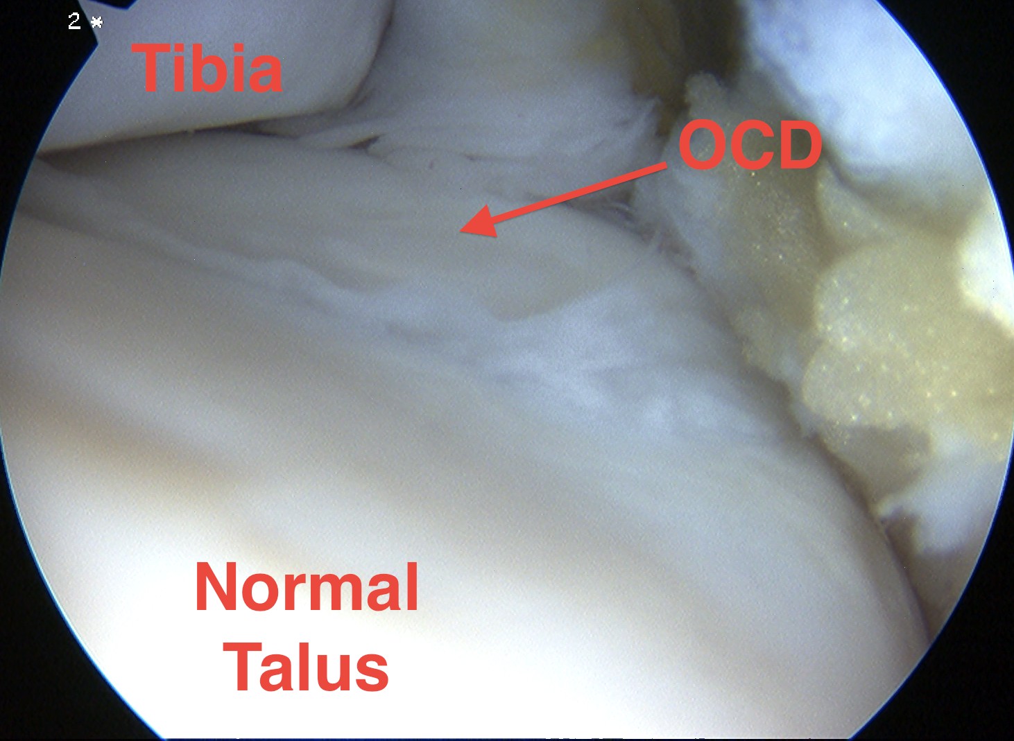 Ankle OCD Arthroscopy